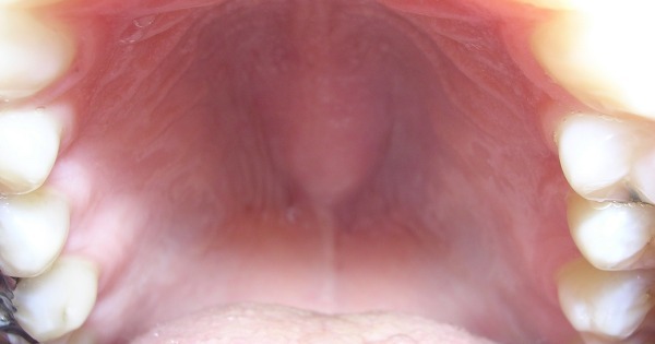papilloma del palato duro hpv virus in neck cancer