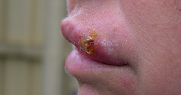 Herpes Labial O Que Quais As Causas Sintomas E Tratamento M Dico