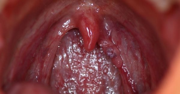papiloma boca sintomas