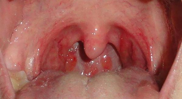 Faringite localizada na parede da garganta