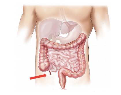 Localização do apendice