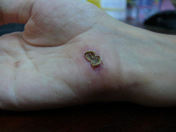 Ferida na palma da mão, com necrose no centro, causada por picada de aranha marrom.