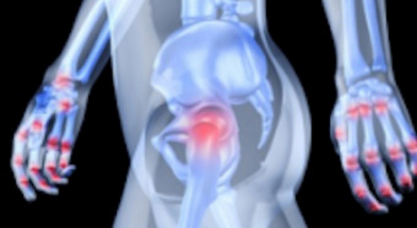 Artrite: sintomas e tratamento