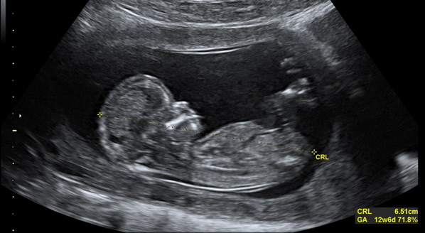Bebê visto através do ultrassom