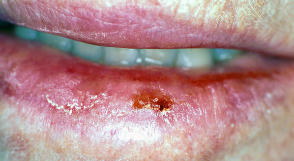 Câncer bucal: causas, sintomas e tratamento