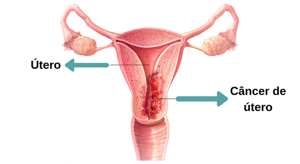 Câncer no colo do útero: sintomas e tratamento