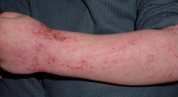 Dermatite atópica tem cura? Como é o tratamento?