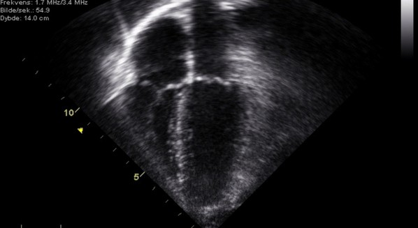 Imagem do coração obtida por ecocardiograma