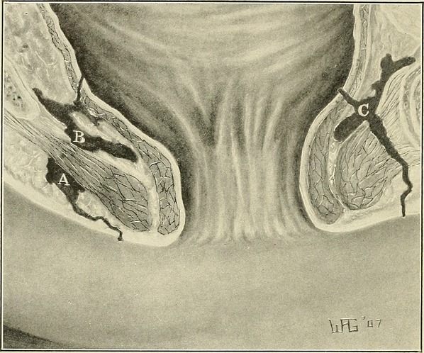 Fístula anal