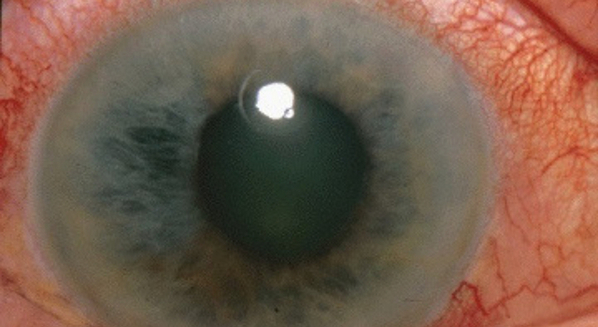 Sintomas e tratamento do glaucoma