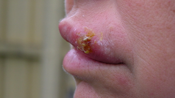 O que é herpes labial, causas, sintomas, contágio, tratamento