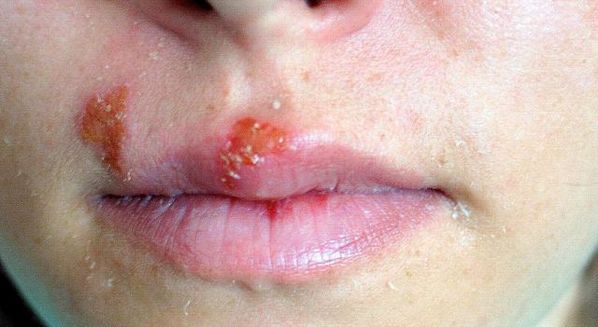 Herpes na boca