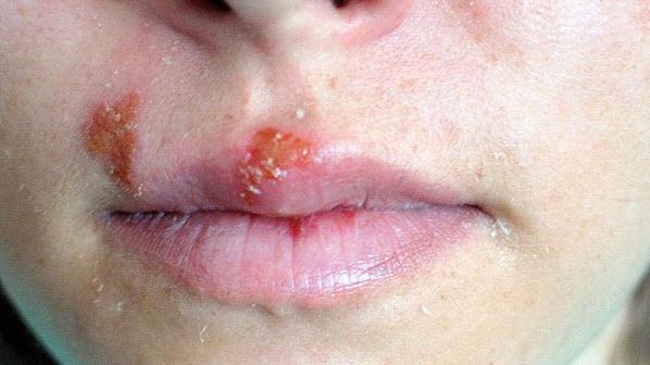O que é herpes simples, quais as causas, os sintomas e como é o tratamento