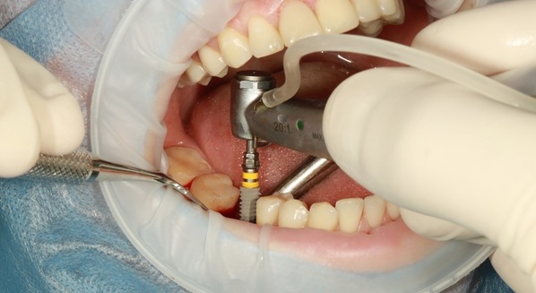 Implante dentário: o que é como é feito