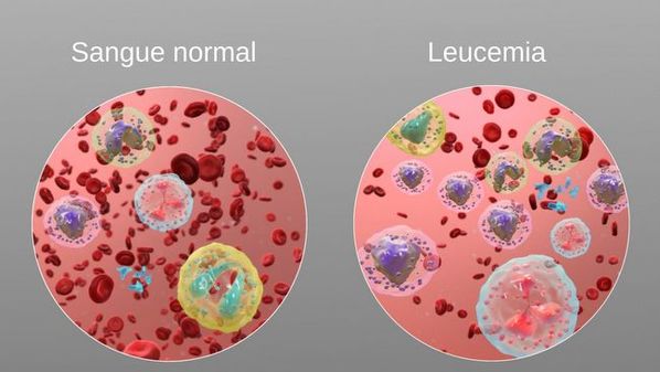 Sintomas de leucemia
