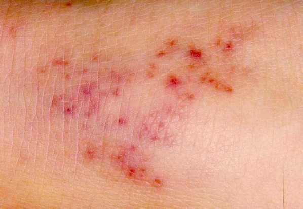 Manchas na pele provocadas por meningite