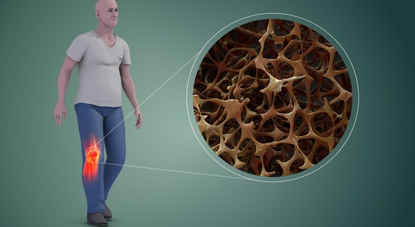 Tratamento da osteoporose