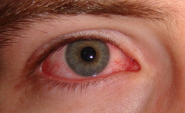 Olho vermelho