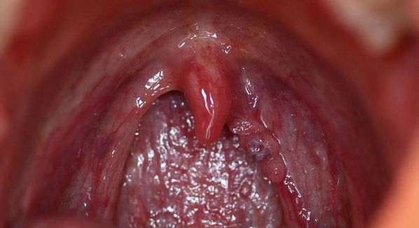 hpv red throat
