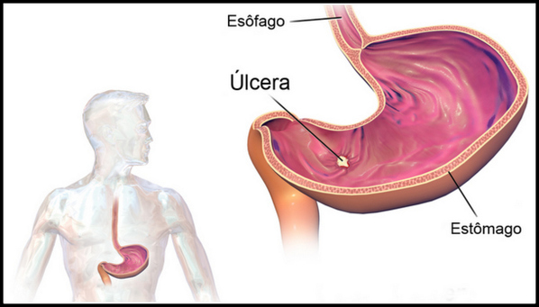 Úlcera gástrica: o que é, sintomas e tratamento da úlcera péptica