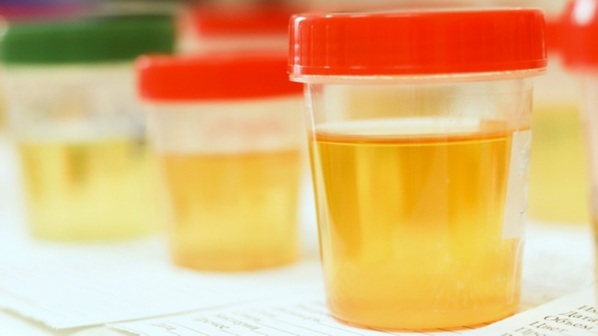O que pode deixar a urina com mau cheiro ou alterar o cheiro normal da urina?