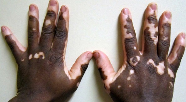 Vitiligo sintomas