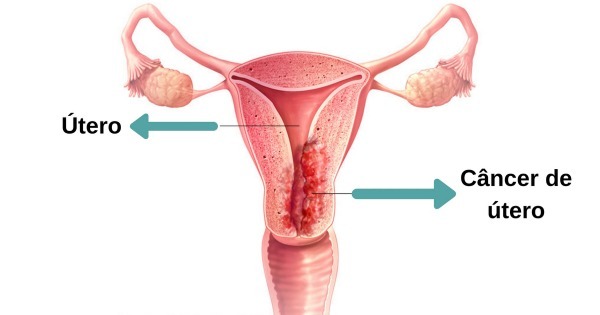 Quais os sintomas de câncer no colo do útero? - Médico Responde