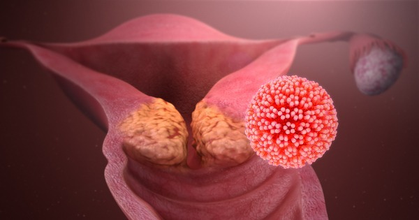 Qual O Tratamento Para Hpv M Dico Responde